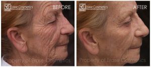 Muriel before and after