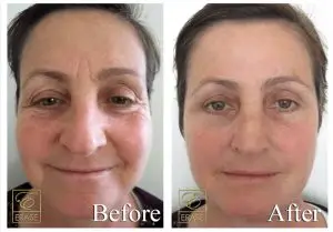 before and after 1