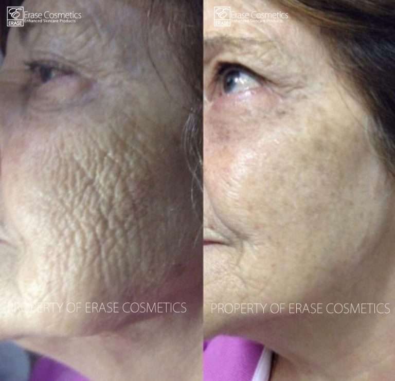 Erase Cosmetics customer results - before and after