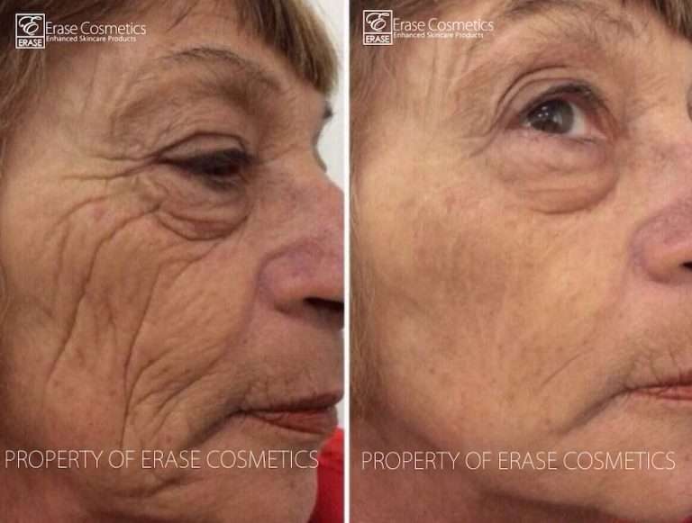 Erase Cosmetics customer results - before and after