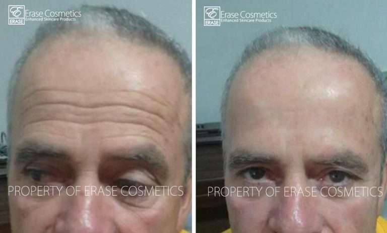 Erase Cosmetics customer results - before and after