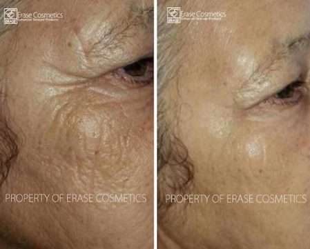 Erase Cosmetics customer results - before and after