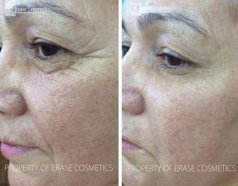 Erase Cosmetics customer results - before and after